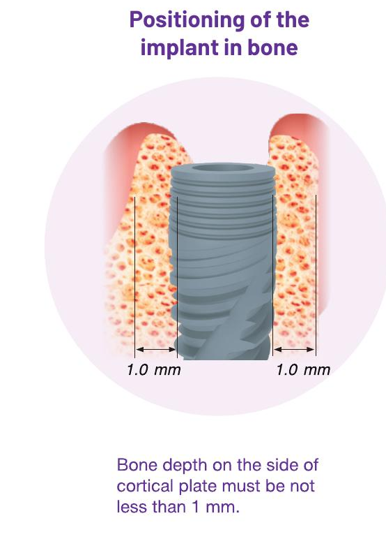 Positioning of the implant in bone