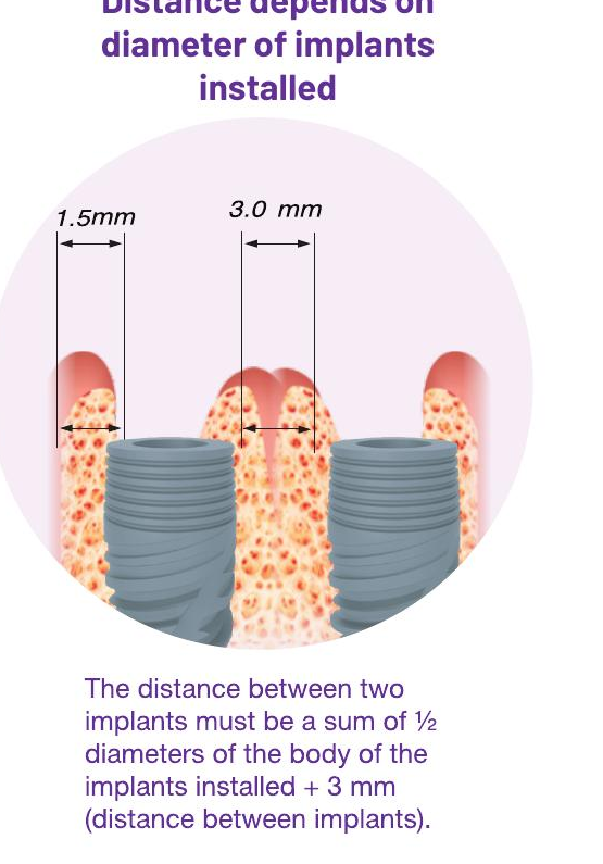 Distance between two implants
