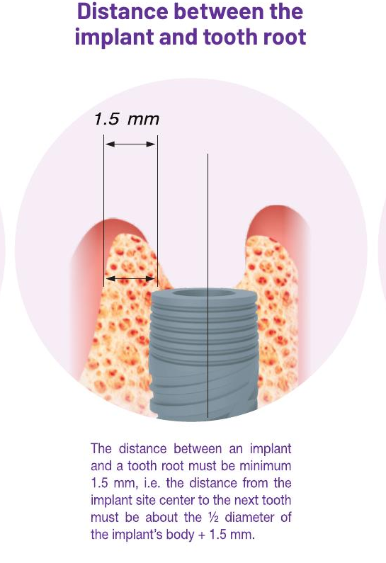 Distance between the implant and tooth root